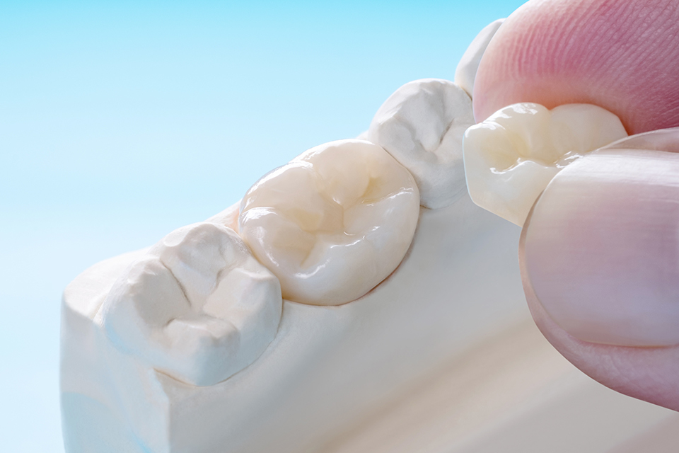 メタルフリー治療