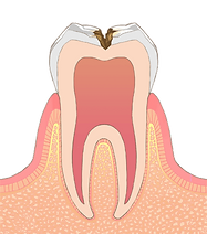C2 象牙質の虫歯