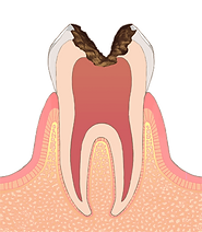 C3 神経まで進行した虫歯