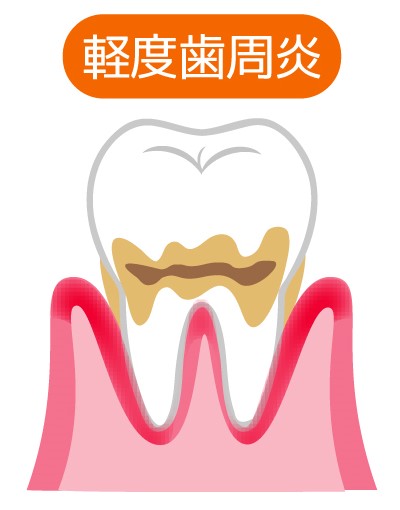 軽度歯周病